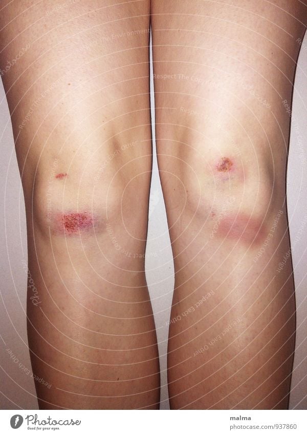 Closeup Of Young Woman Legs With Surgery Scar On Her Leg by