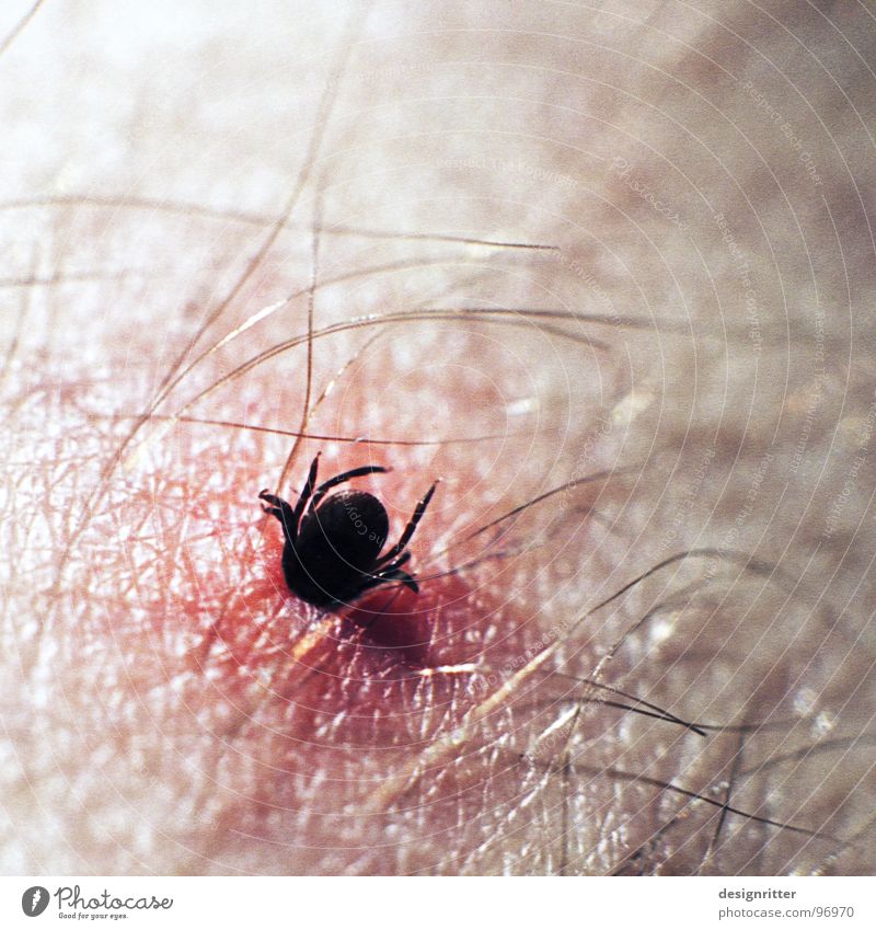 The head stayed inside Tick Illness Extract Dangerous tick bite ixodida Skin Hair and hairstyles Lyme disease Death Threat Wound